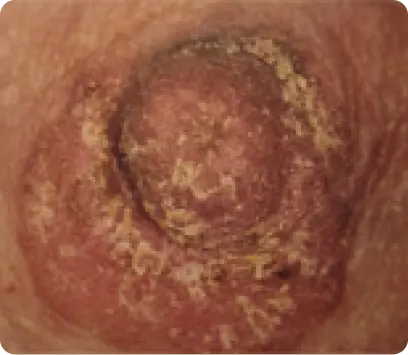 Paget du mamelon, forme rare du cancer du sein