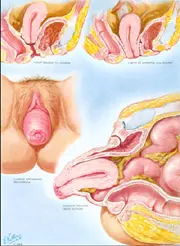 Différents stades du prolapsus genital femme