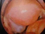 Ligature des trompes Coelioscopie