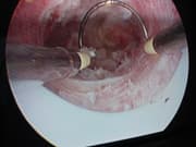 Resection hysteroscopique